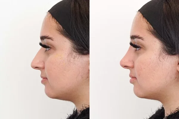 Non Surgical Rhinoplasty Treatment Before & AFter Results in Riyadh Enfiel Royal Clinic Saudi (1)