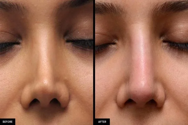 Non Surgical Rhinoplasty Treatment Results Before & After Enfield Royal Clinic (1)