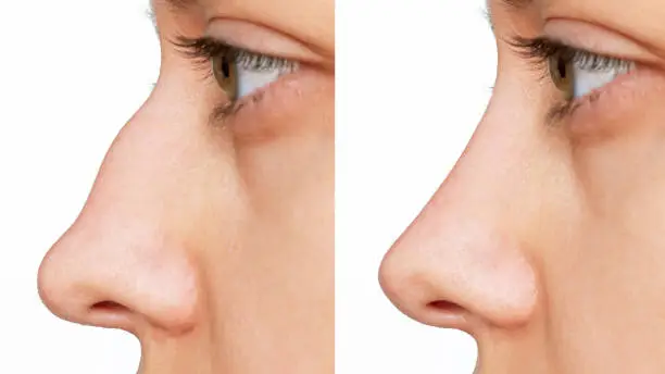 Nose Tip Plasty results before and after Riyadh (1)