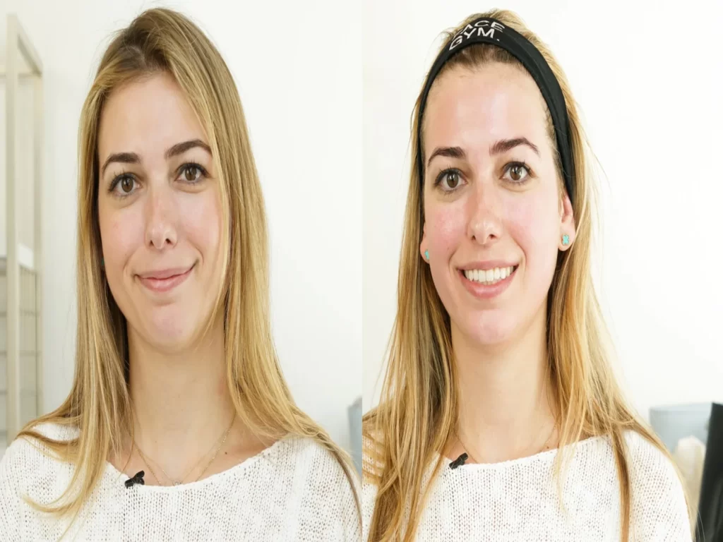 Oxygen Facials in Riyadh Before & After Result Enfield Royal Clinic (1)