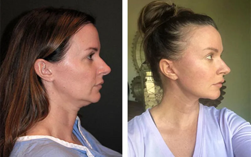 Ponytail Facelift Before & After Results in Riyadh Enfield Royal Clinc