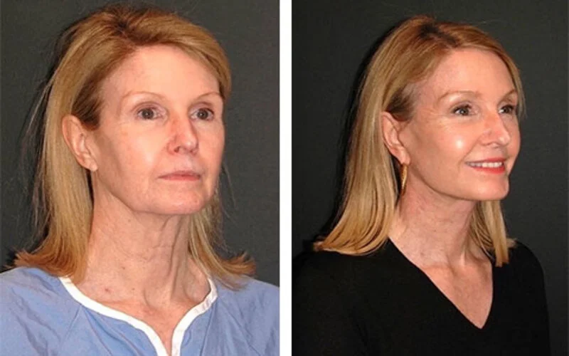 Ponytail Facelift in Riyadh Before & After Results Enfield Royal Clinic Saudia