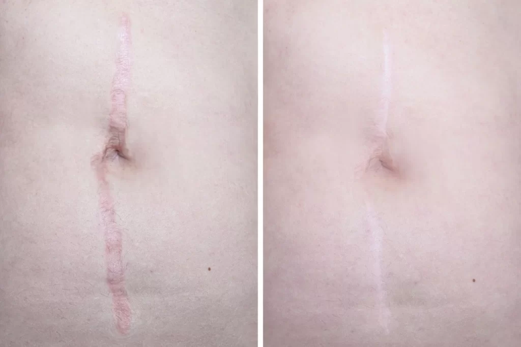 Post Surgical Scar Treatment in riyadh before and after