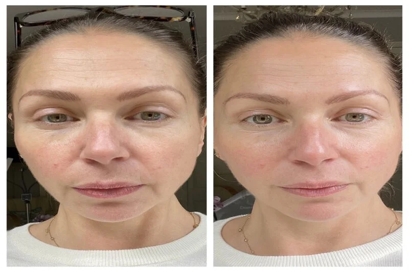 Red Carpet Facial in Riyadh results before and after