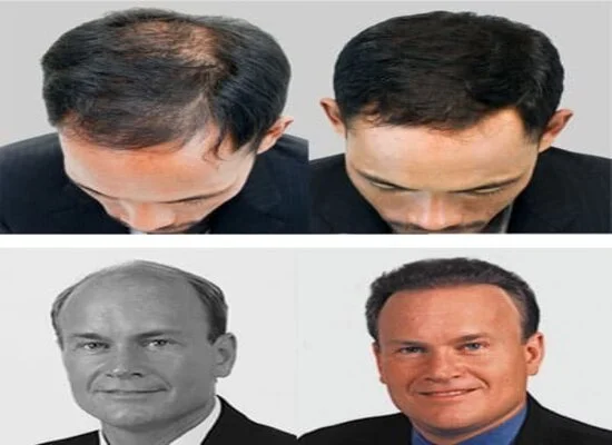 Robotic Hair Transplant in riyadh before and after
