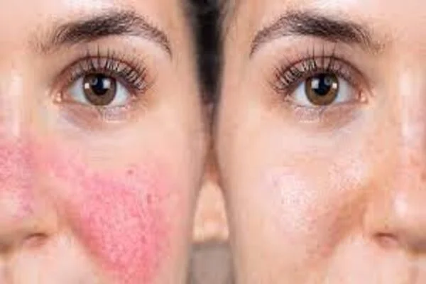 Rosacea Treatment in Riyadh before and after