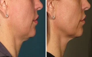 Sagging skin ultherapy before and after in riyadh