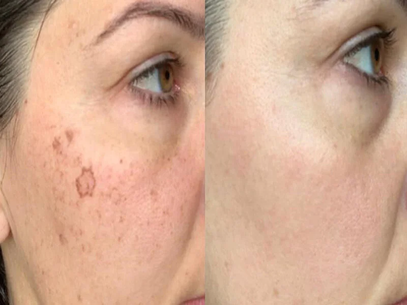 Say Goodbye to Imperfections with Dermal Pigmentation before and after in Riyadh
