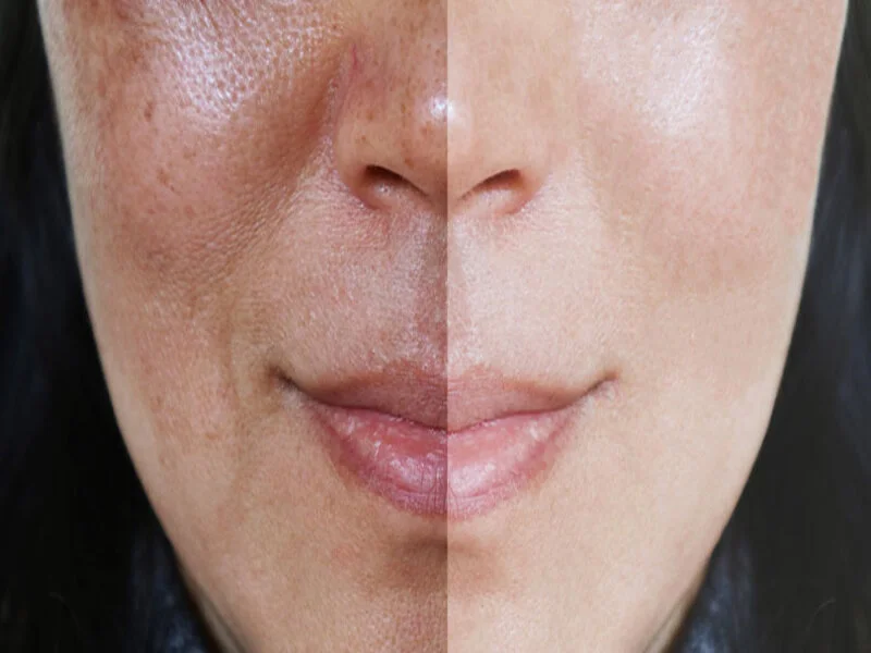 Say Goodbye to Imperfections with Dermal Pigmentation before and after result in Riyadh