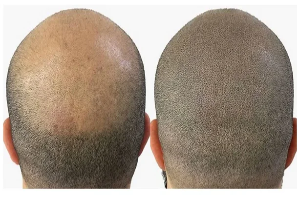 Scalp Micropigmentation before and after (1) (1)