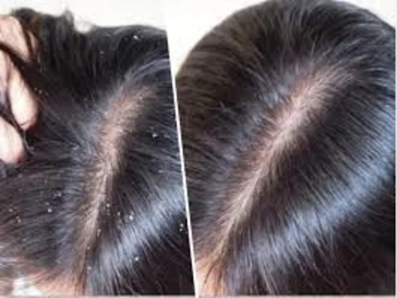 Severe Dandruff Treatment Before And After Resullt in Riyadh