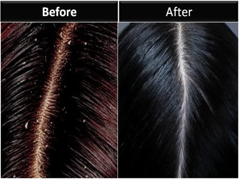 Severe Dandruff Treatment in Riyadh Before & After Result