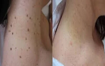Skin Tag Removal before and after result,2