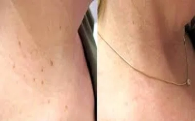 Skin Tag Removal before and after results,1