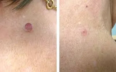 Skin Tag Removal before and after results,3