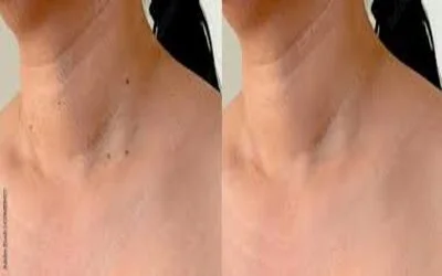 Skin Tag Removal beforeand after results,4