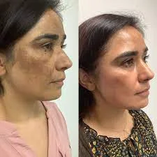 Skin pigmentetion before and after results in riyadh
