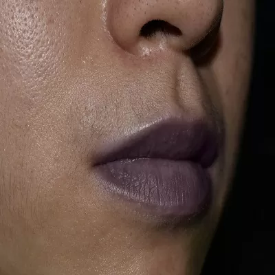 Smoker Lips Treatment in Riyadh