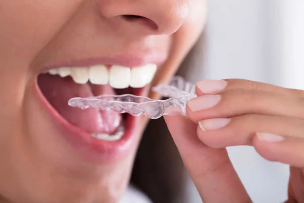 Teeth Mouthguards cost in Riyadh