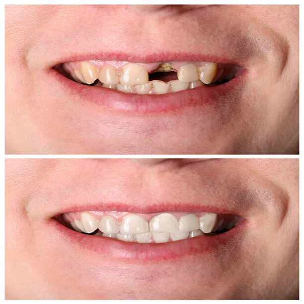 Tooth Removal in Riyadh before and after results
