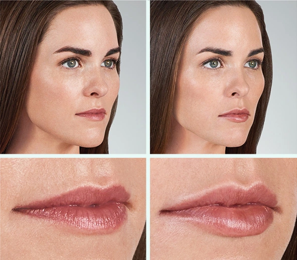 Volbella Fillers before and after result in Riyadh