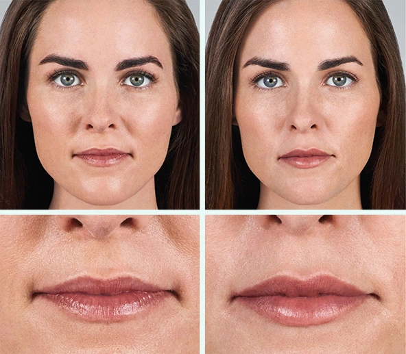 Volbella Fillers in Riyadh Before & After Result