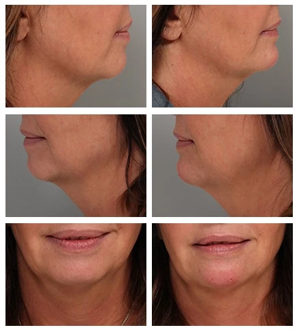 Voluma fillers before and after results in Riyadh