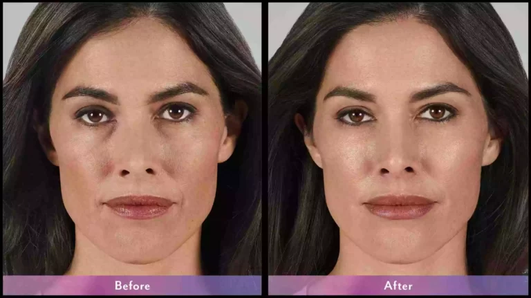 beletero fillers before after results in riyadh