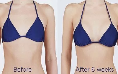 brava breast augmentation before after in riyadh