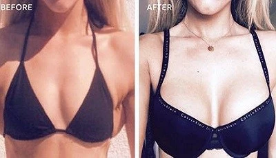 brava breast augmentation before after results in riyadh