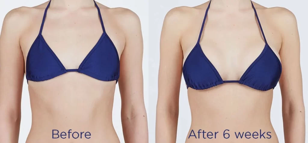 breast augmentation results in riyadh