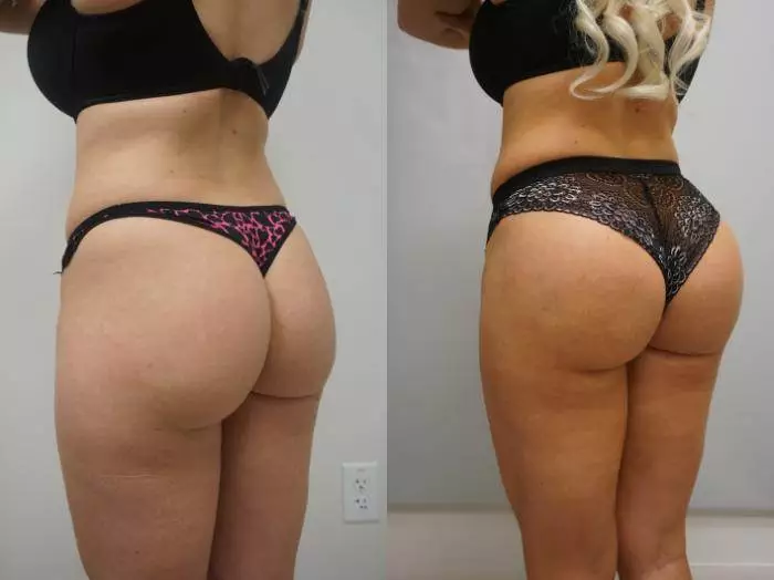butt lift before after in riyadh