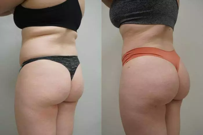 butt lift before after results in riyadh