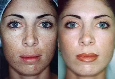 chemical peels before after results in riyadh