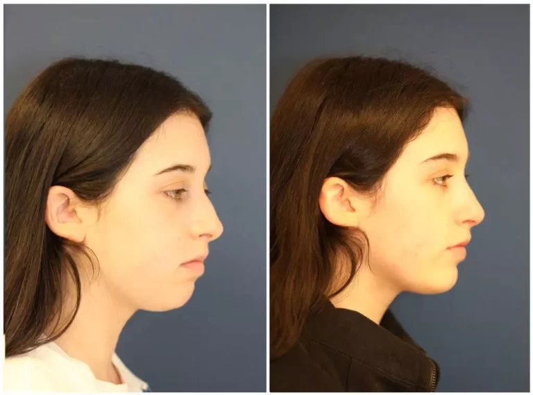 chin augmentation before after results in riyadh