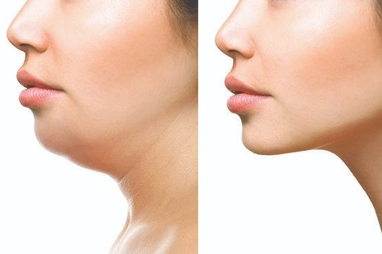chin reduction before after in riyadh