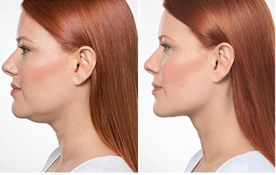 chin reduction before after results in ryadh