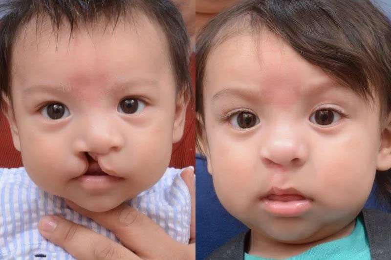cleft lip surgery before after in riyadh