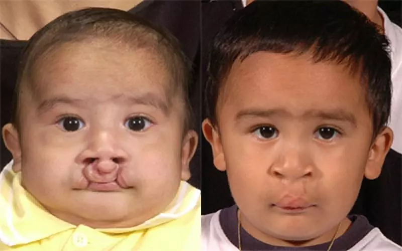 cleft lip surgery before after results in riyadh