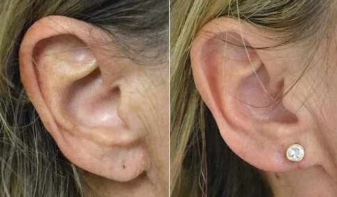 ear piercing before after in riyadh