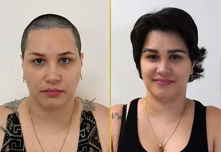 female hair transplant before after results in riyadh (2)