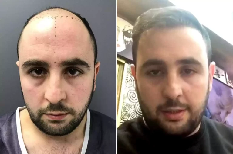 hair transplant before after results in riyadh