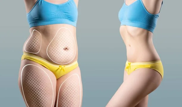 liposuction before and after in riyadh