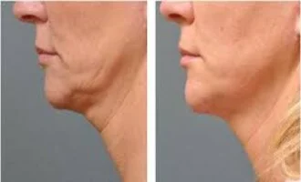 sagging skin before and after in riyadh,1