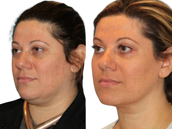 sculptra fillers in riyadh before and after in riyadh results