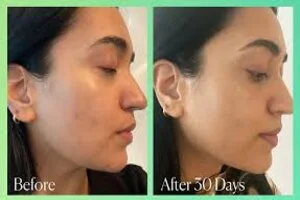 skin pigmentetion before and after in riyadh