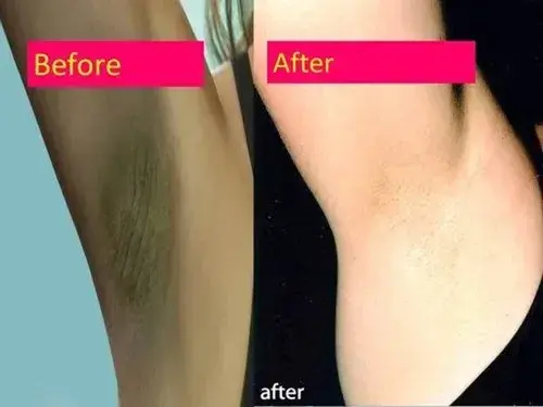 Armpit Whitening Method Best Surgery Clinic ERS