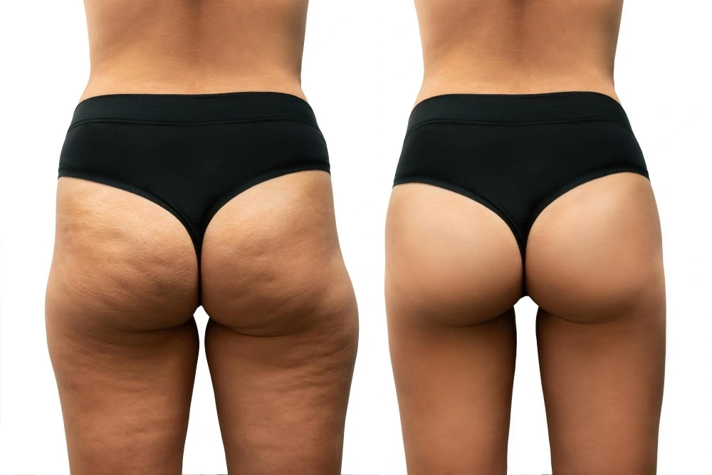 Before After of French butt reshaping in Riyadh