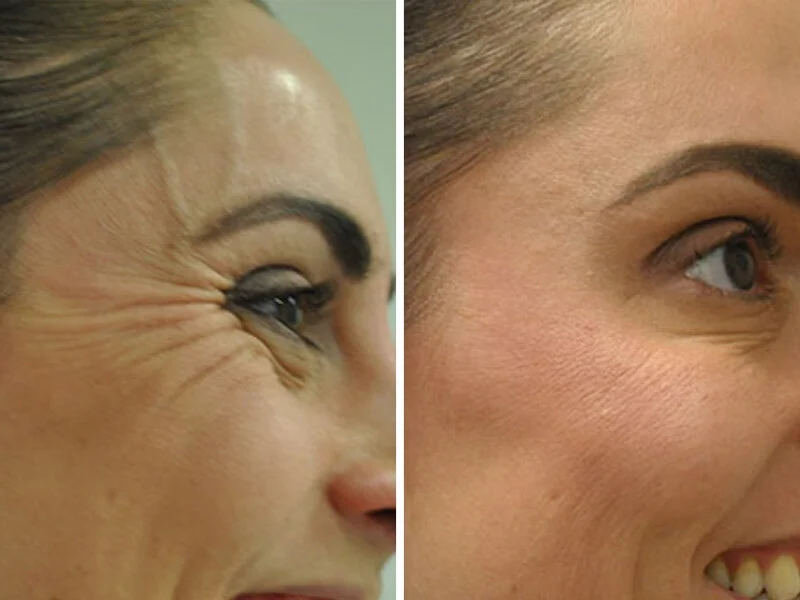 Botox Injections for Wrinkles in Riyadh Before & After Result