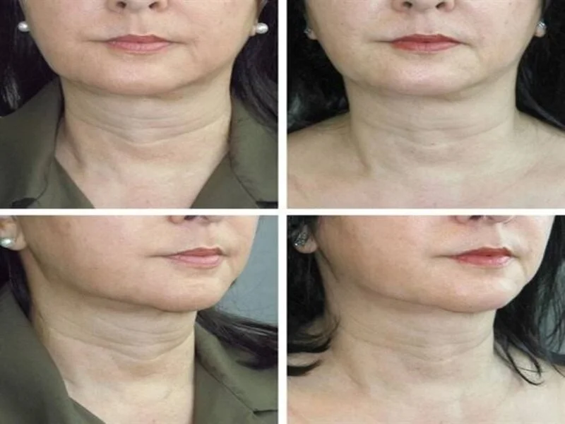 Botox Injections for Wrinkles in Riyadh Before And After Results